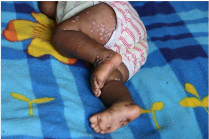 Alerte sanitaire au Nord-Kivu : un cas de variole de singe confirmé à Oicha