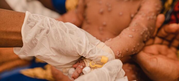 Crise sanitaire en RDC : L'OMS alerte sur l'effondrement des systèmes de santé dans l'Est du pays