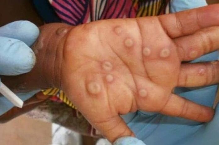 Un premier cas de Monkeypox détecté dans le Haut-Uele : alerte sanitaire en cours