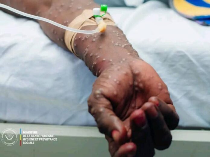 Mpox en RDC : 2.693 cas suspects en deux semaines, la vaccination s'accélère face à l'urgence sanitaire